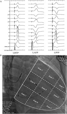 Comparison of electrocardiogram parameters and echocardiographic response between distinct left bundle branch area pacing modes in heart failure patients